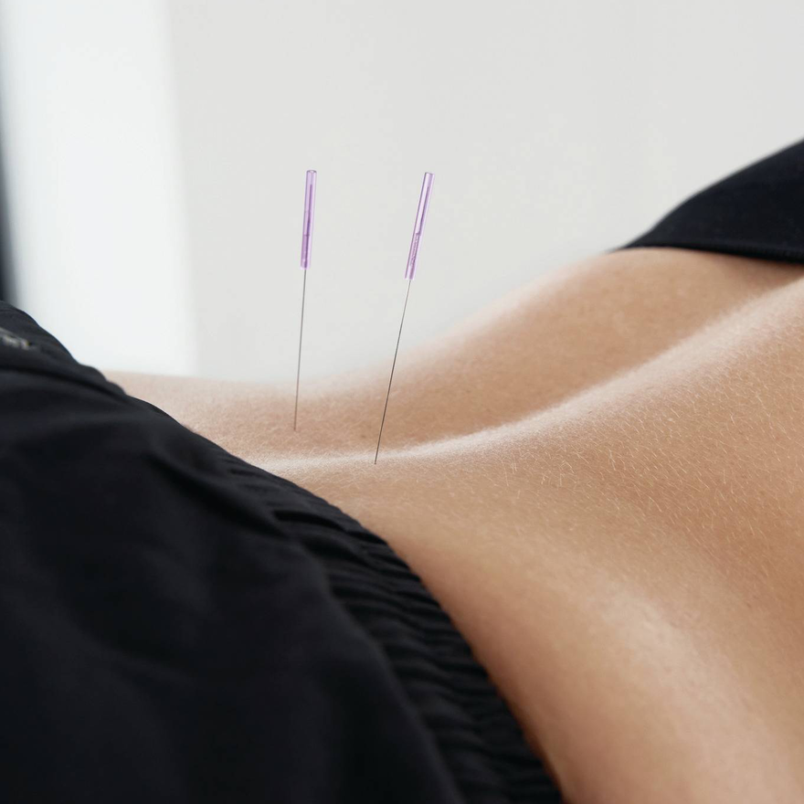 Akupunktur am Rücken als Ergänzung der Standardtherapie