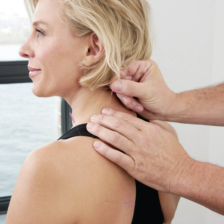 Dry Needling an bestimmten Triggerpunkten in den Muskeln